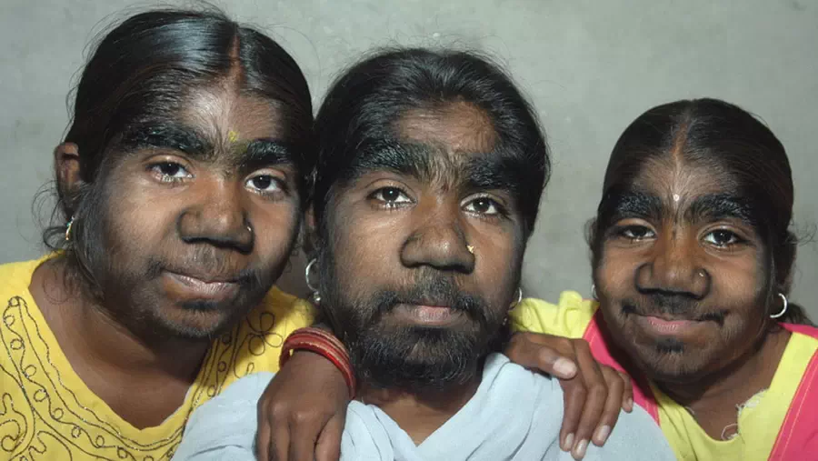 Werewolves - hypertrichosis.